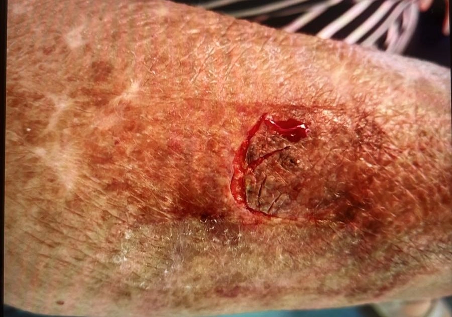 Die Schmeterlingspflege - Ambulanter Pflegedienst - Wunde